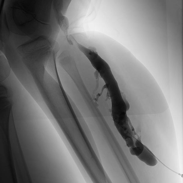 Phlebography: large-lumen drainage vein