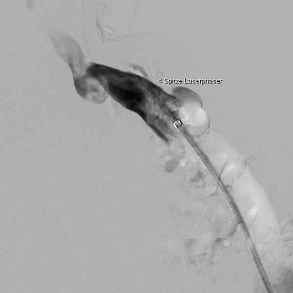 Laser fiber is advanced through this sheath for endovascular laser therapy