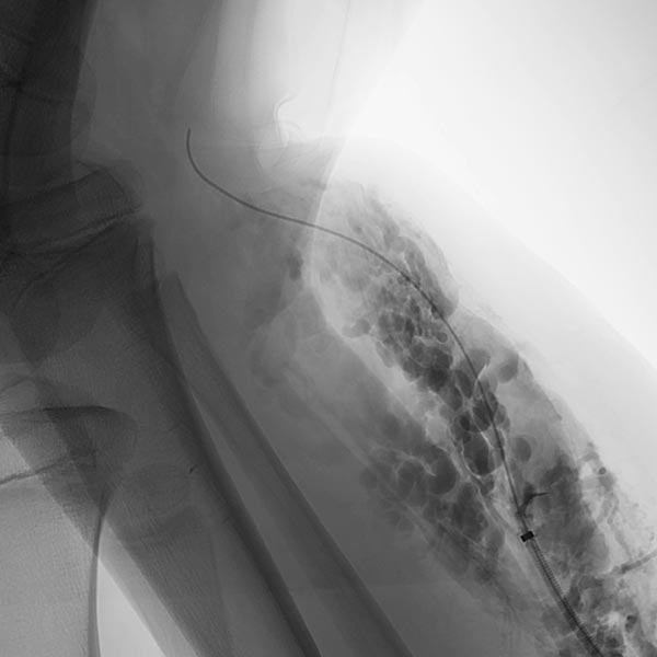 Laser fiber and contrast injection via the pulled-back introducer sheath
