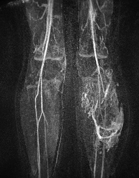 MR angiography: venous malformation