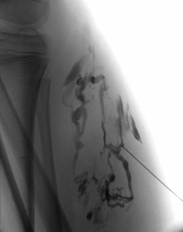 Phlebography: direct puncture