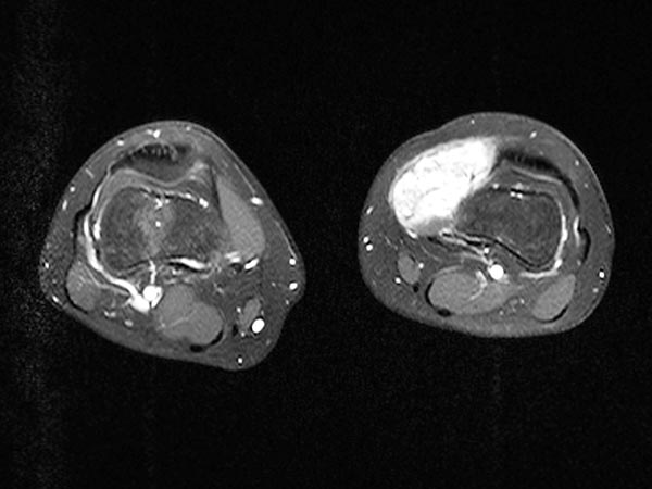 MRI: venous malformation