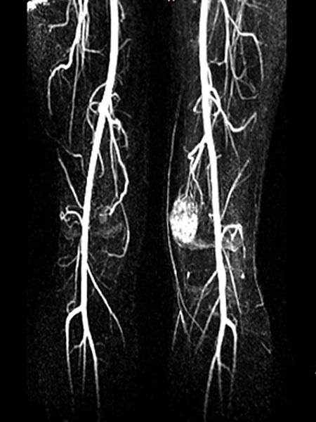 MR angiography: venous malformation
