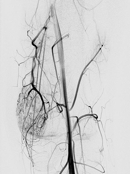DSA: arteriovenous fistulas
