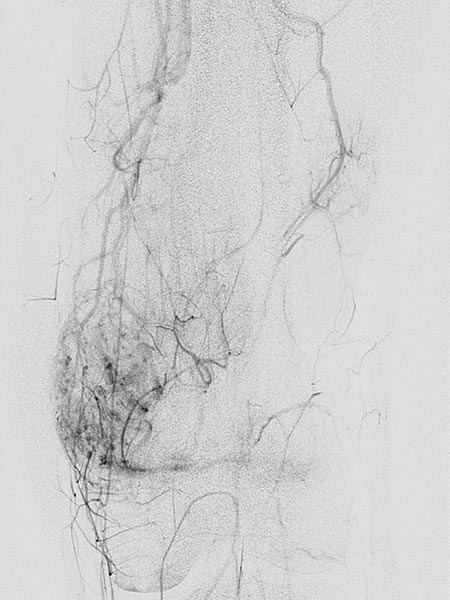 Digital subtraction angiography: venous malformation