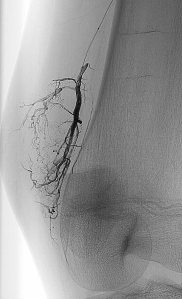 X-ray: AV fistulas