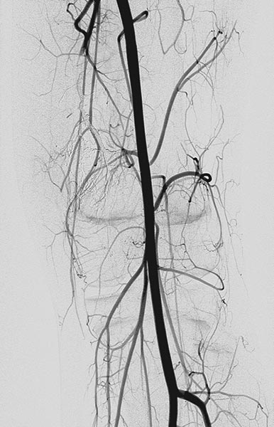 DSA: after embolization