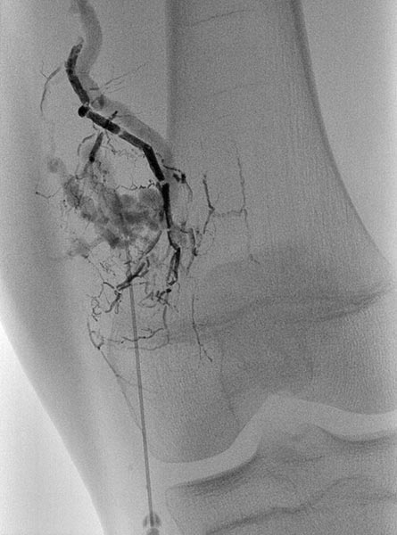 Sclerotherapy: direct puncture technique