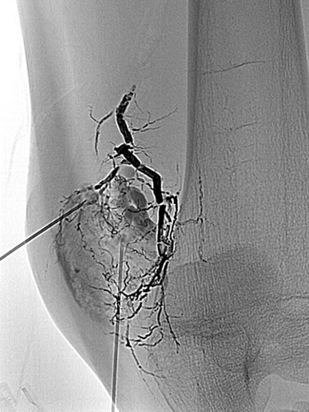 After occlusion of the drainage, complete sclerotherapy of the VM was possible because the liquid sclerosing agent could no longer drain off via the communicating vein.