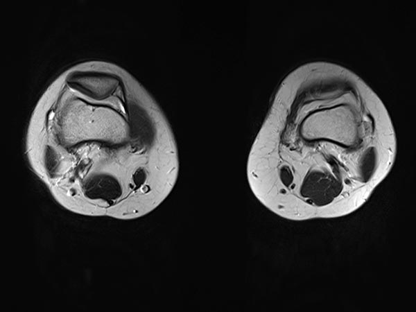 MRI: completely occluded venous malformation