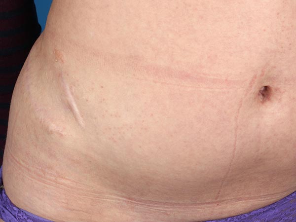 Lymphatic malformation of the abdominal wall