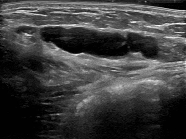Sonography: macrocystic malformation on the abdominal wall
