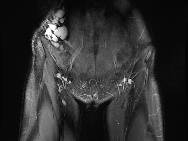 MRI: large, dysplastic, balloon-like, septated cysts