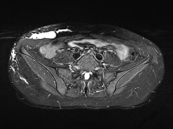 MRI: additional extension of the lymphatic malformation