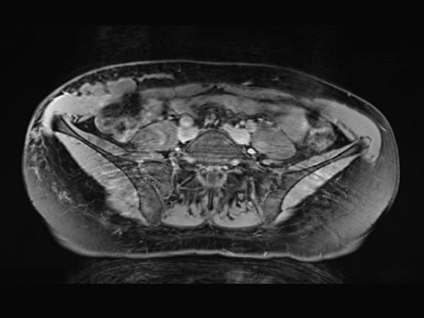 MRI: minimal enhancement of the thin walls of the lymphatic malformation