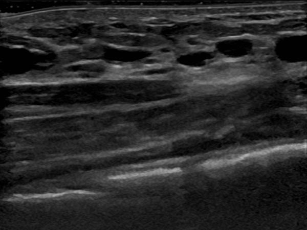 Sonography: only very small cystic parts of the lymphatic malformation