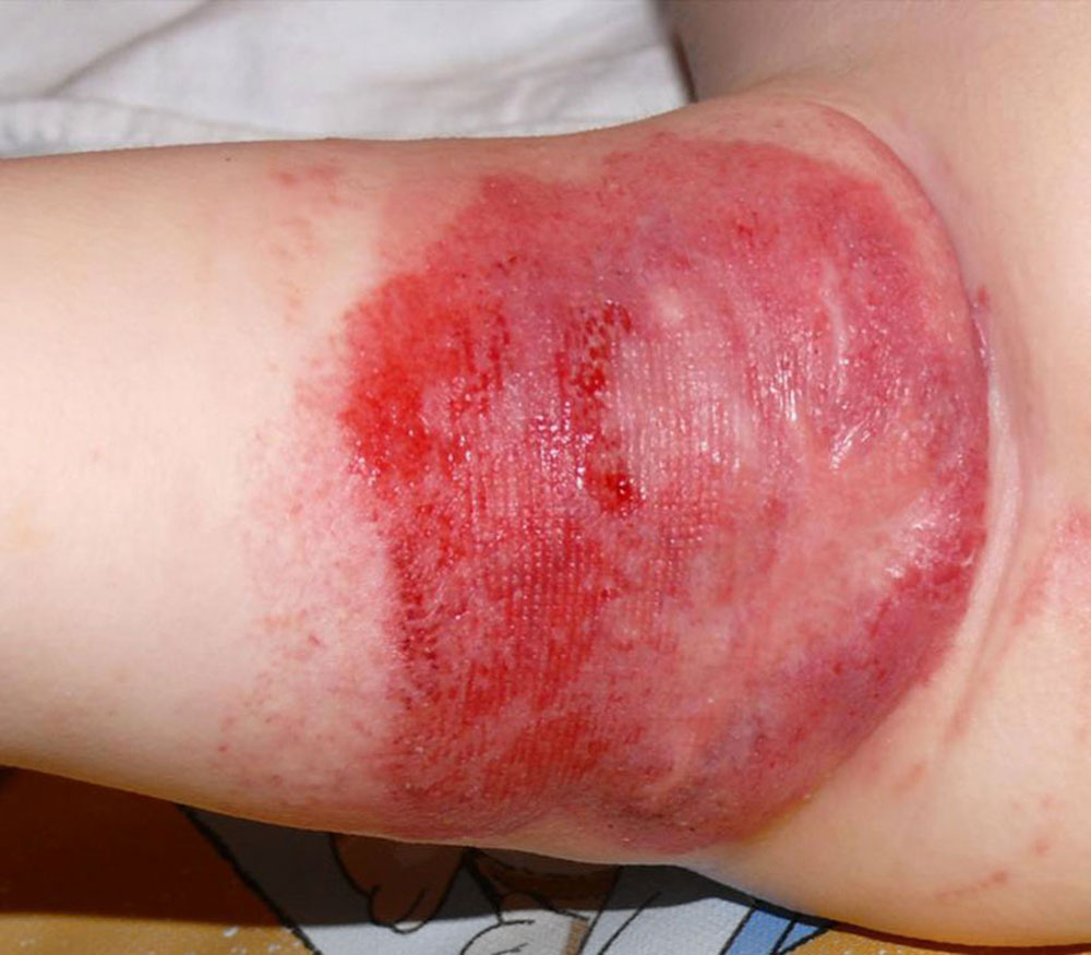 Typical infantile hemangioma