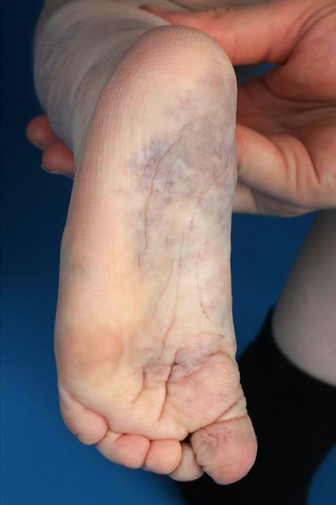 Venous malformation on a boy’s foot