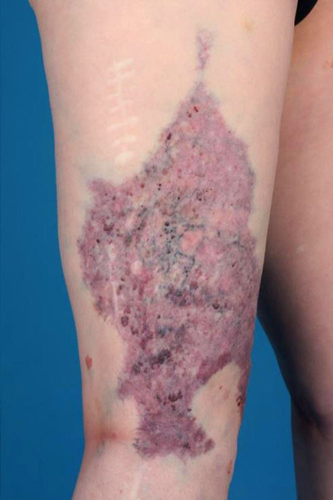 Typical combined capillary-venous malformation
