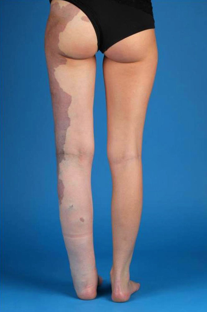 Typical Klippel-Trénaunay syndrome with overgrowth of the left leg