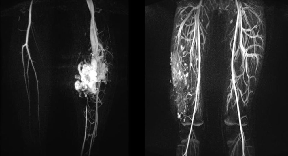 MR angiography