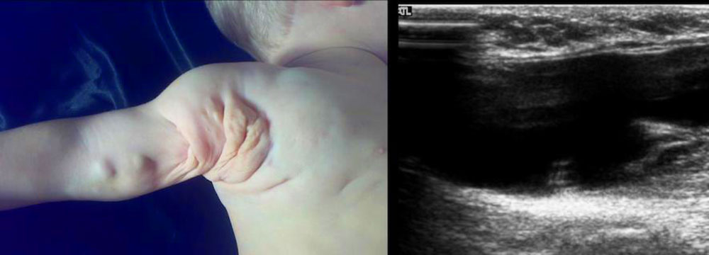 Lymphatic malformation