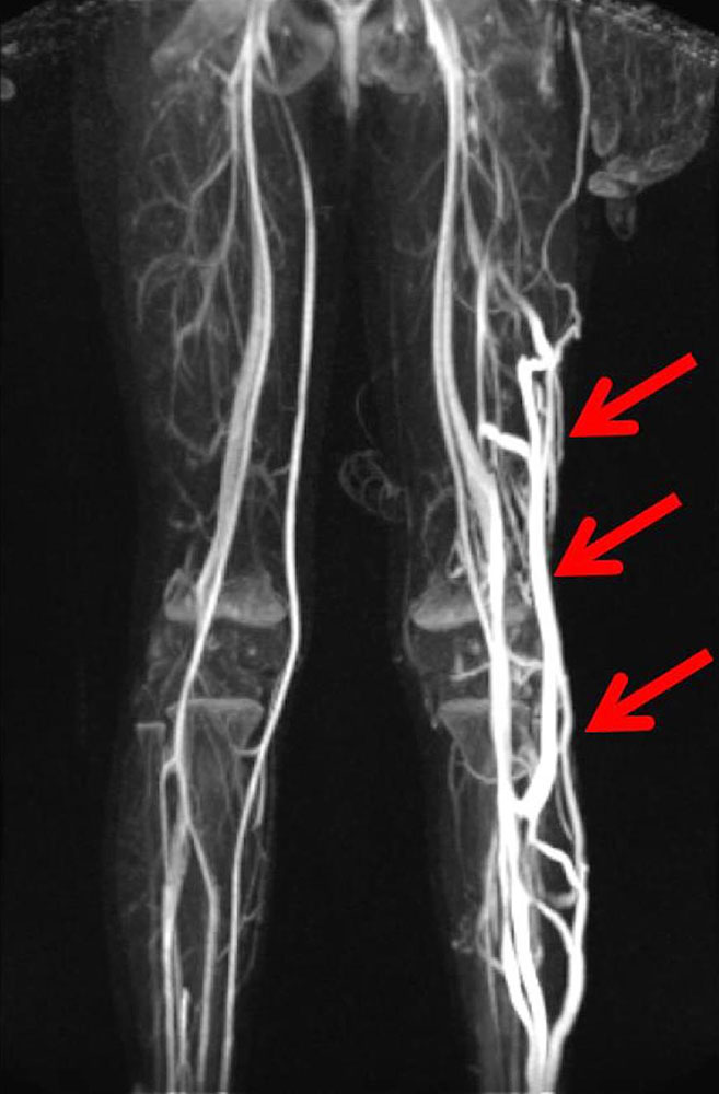 Large, dilated marginal vein on the left leg in MR angiography