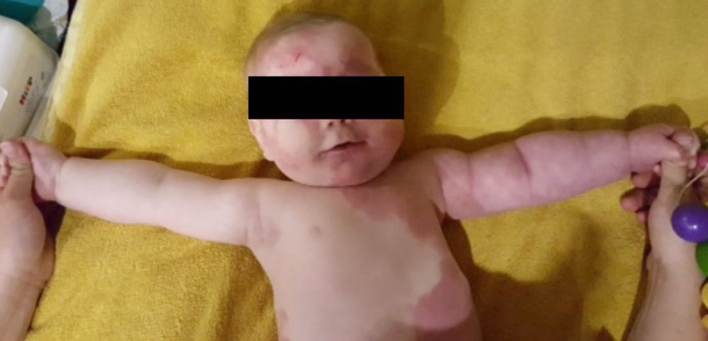 Infant with Sturge-Weber syndrome