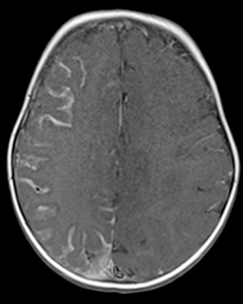 T1-weighted MRI – Sturge-Weber syndrome