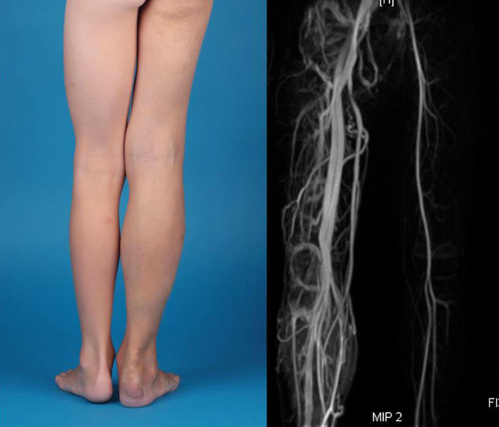 Patient with Parkes Weber syndrome