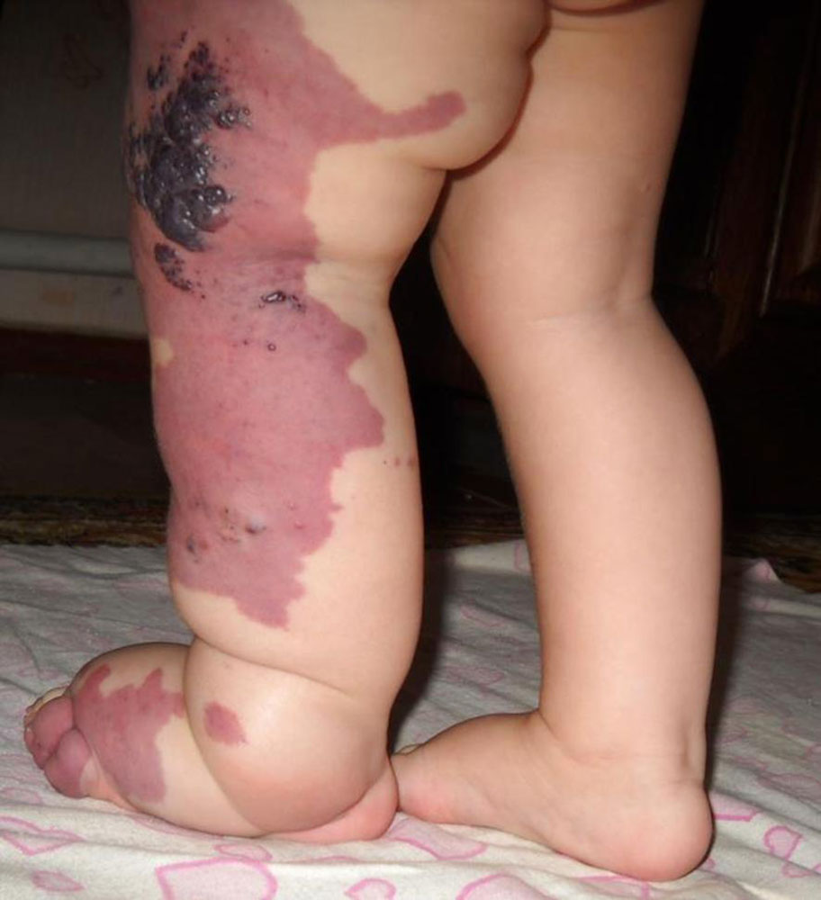 Baby with Klippel-Trénaunay syndrome
