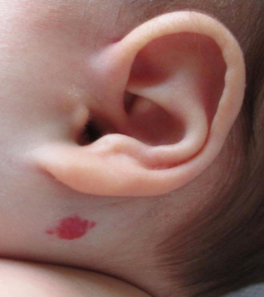 Infantile hemangioma