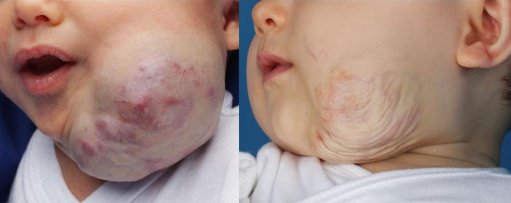 Congenital hemangioma of the rapidly involving type