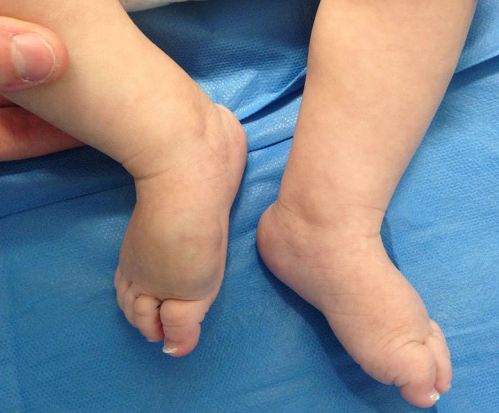 Vascular tumor on dorsum of the right foot