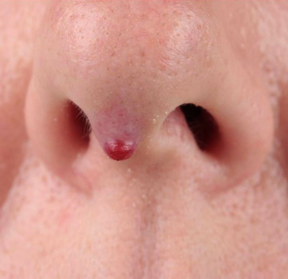 Granuloma pyogenicum of the nose
