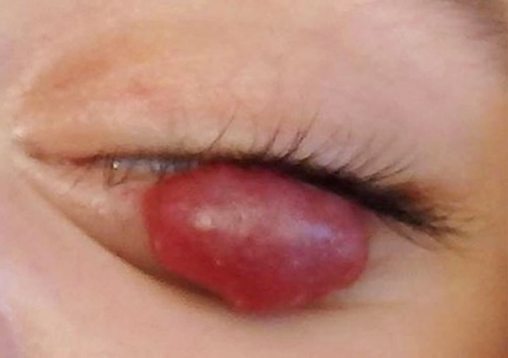 Infantile hemangioma at the lower eyelid