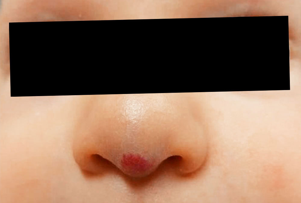 Infantile hemangioma at the tip of the nose