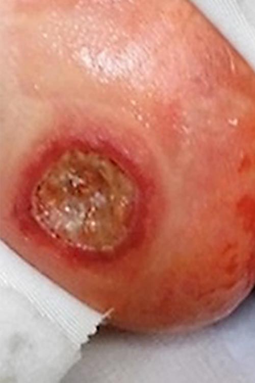 Ulcerated infantile hemangioma