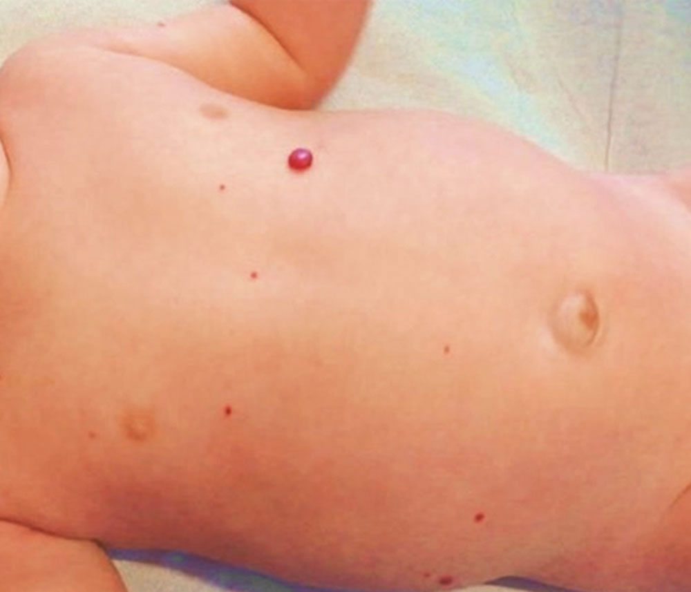 Infant with multifocal infantile hemangioma