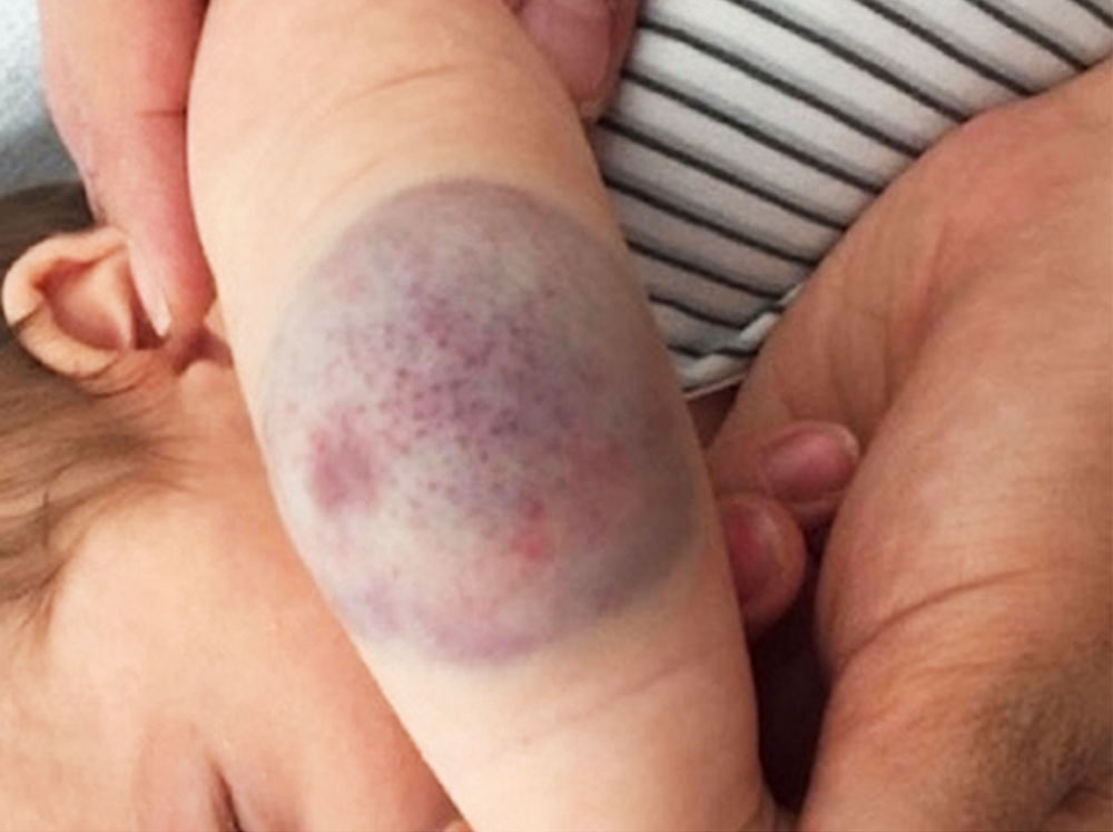 Typical congenital hemangioma on the left forearm