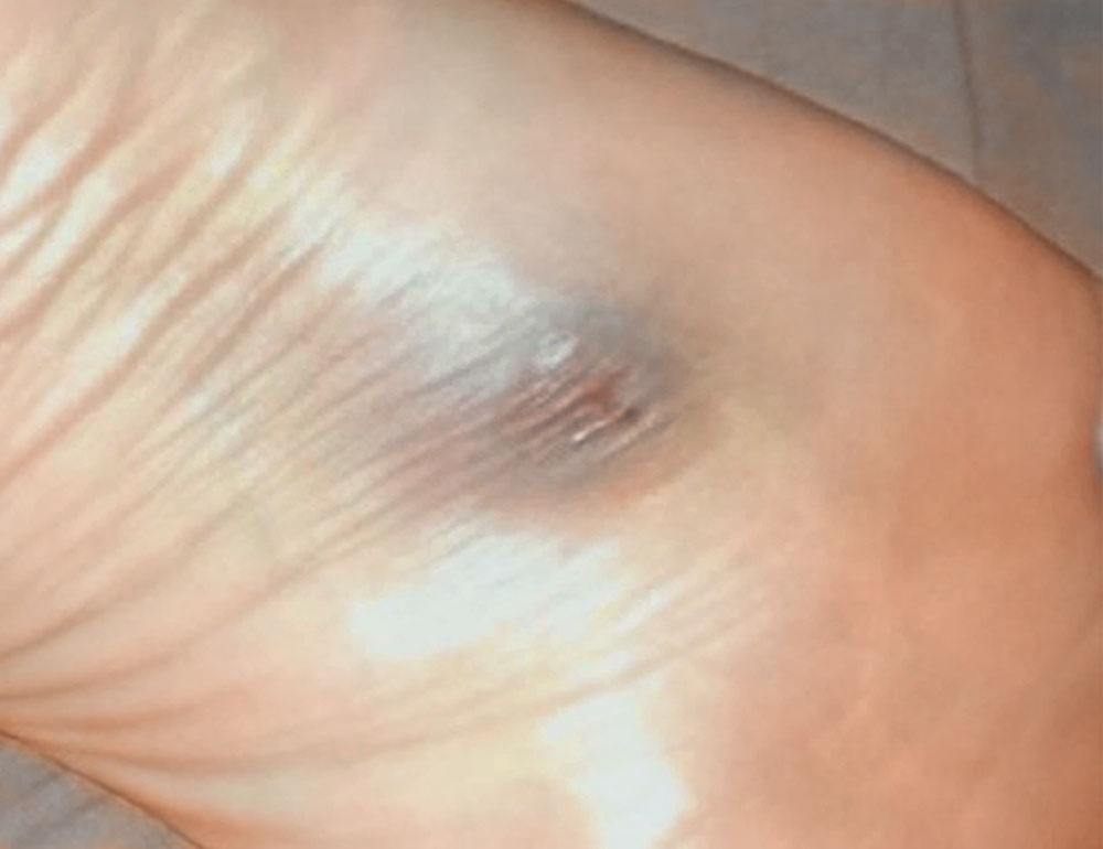Spindle cell hemangioma on the sole of the foot