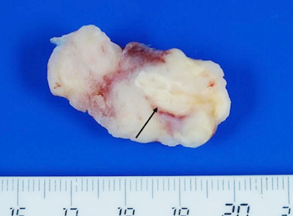 Surgical specimen of an angiosarcoma of the heart