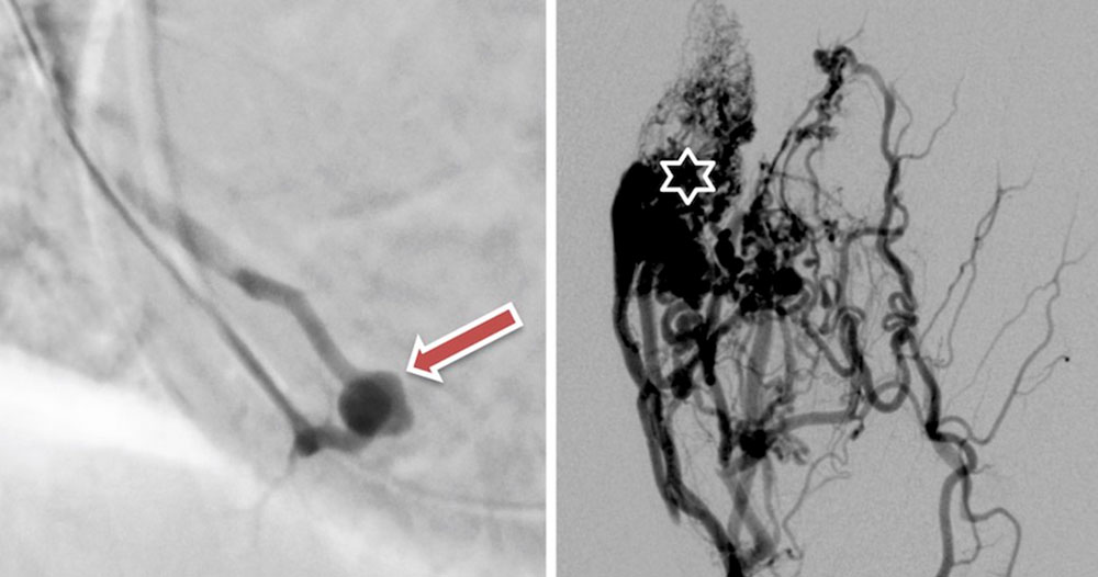 Angiographic image – Pulmonary arteriovenous fistula