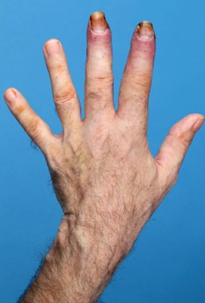 Venous edema of the finger
