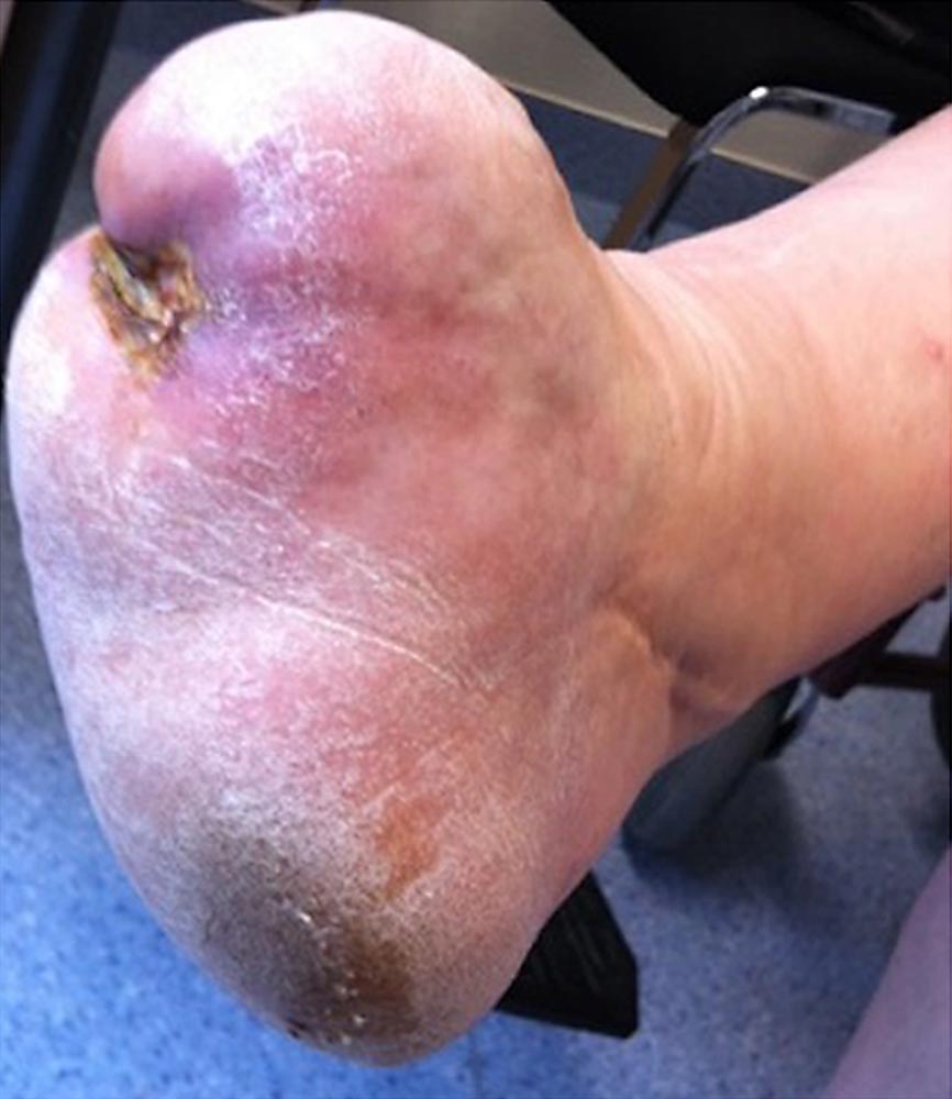 Hyperplasia of the right foot stump