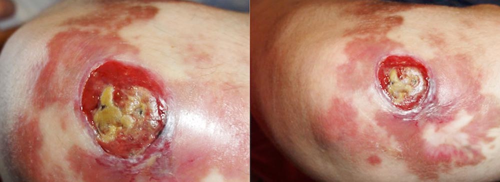 Patellar region with persistent chronic ulceration