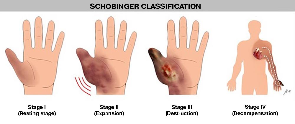 Illustration: Schobinger classification