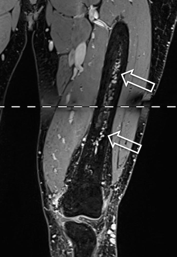 [Translate to English:] MRI – Arteriovenous malformation