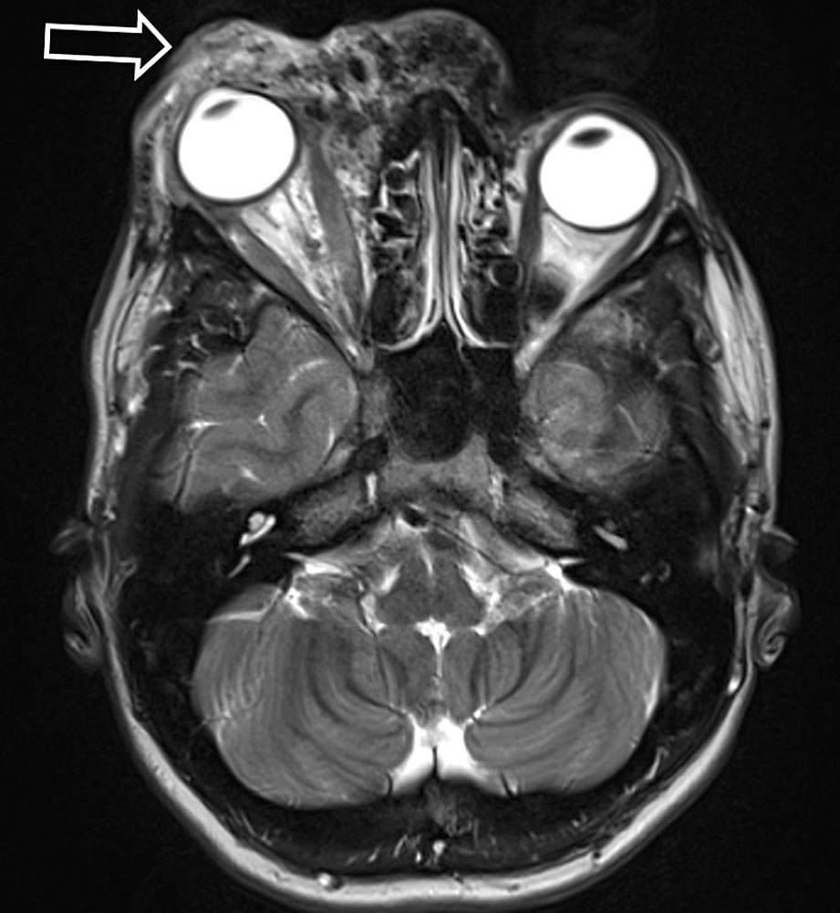 [Translate to English:] MRI – Lateral displacement of the right eyeball