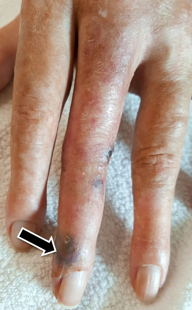 Typical violet-reddish skin changes to the middle finger